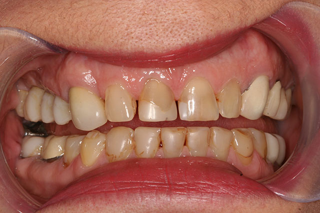 Port Chester Before and After Teeth Whitening